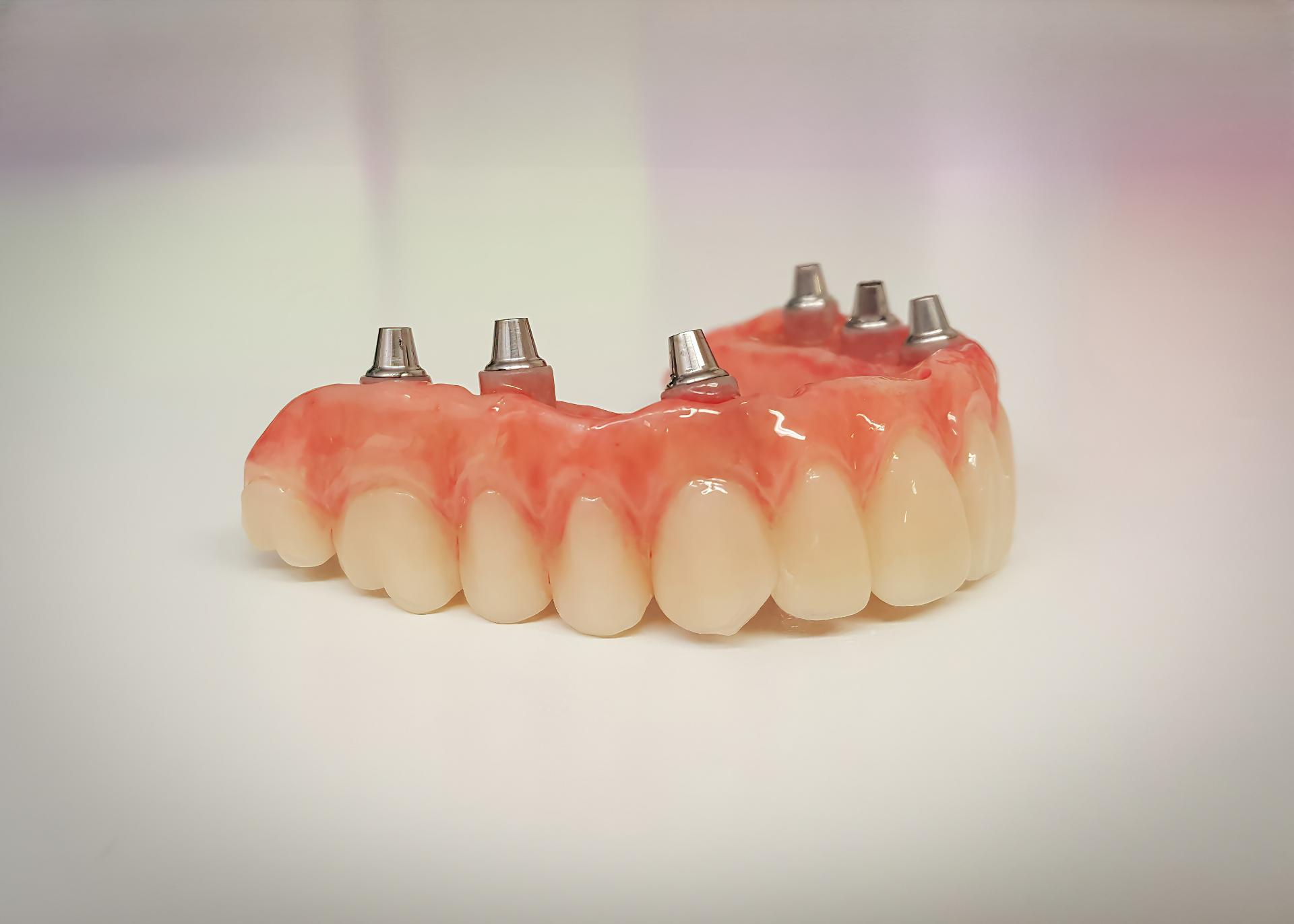 Implant Supported Dentures